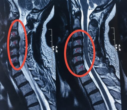 MRI image of compressed vertebrae pressing on spinal cord.