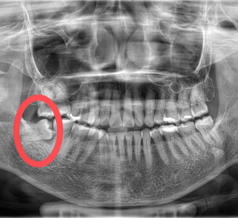 Xray image of impacted wisdom tooth.